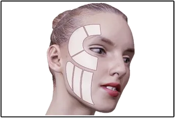 Écran de l'interface HIFU LIFT : quadrillage des zones du visage